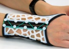Las prótesis y accesorios ortopédicos fabricados con impresoras 3D ya son una realidad Las prótesis y accesorios ortopédicos fabricados con impresoras 3D ya son una realidad
