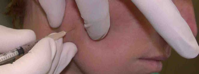 Actavis compra el fabricante de Botox por 53.000 millones
