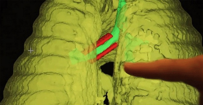 Las impresoras 3D pueden salvar la vida de niños con enfermedades incurables