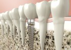 El implante, ¿en mi dentista o en una franquicia dental? El implante, ¿en mi dentista o en una franquicia dental?