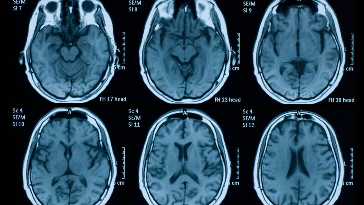 Un algoritmo detecta hemorragias cerebrales con más acierto que la mitad de los radiólogos