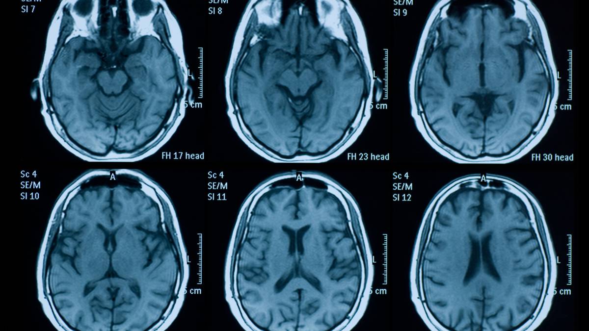 Inteligencia artificial y música para la recuperación de pacientes con ictus