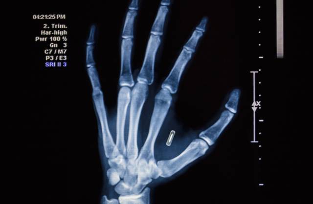 Radiografía de una mano con un implante inteligente.