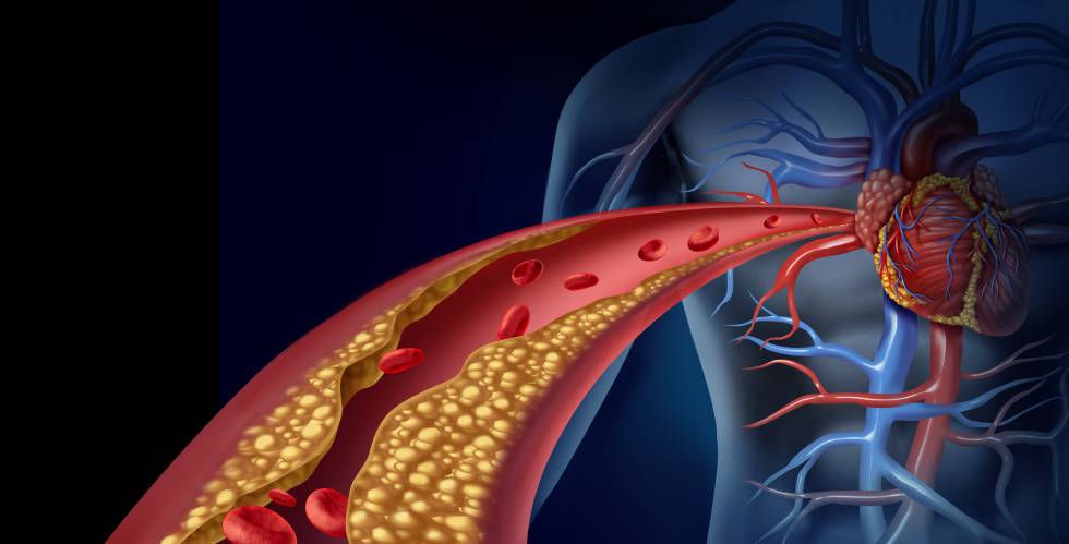 dolor muscular por síntomas de estatinas de diabetes